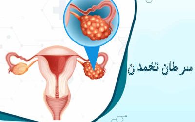 در مورد سرطان تخمدان چه می دانید؟!