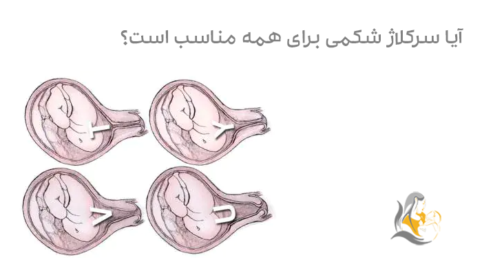آیا سرکلاژ شکمی برای همه مناسب است؟