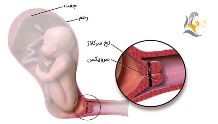 سرکلاژ شکمی